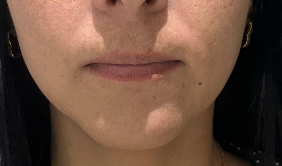 Resultado labios paciente 1 - antes