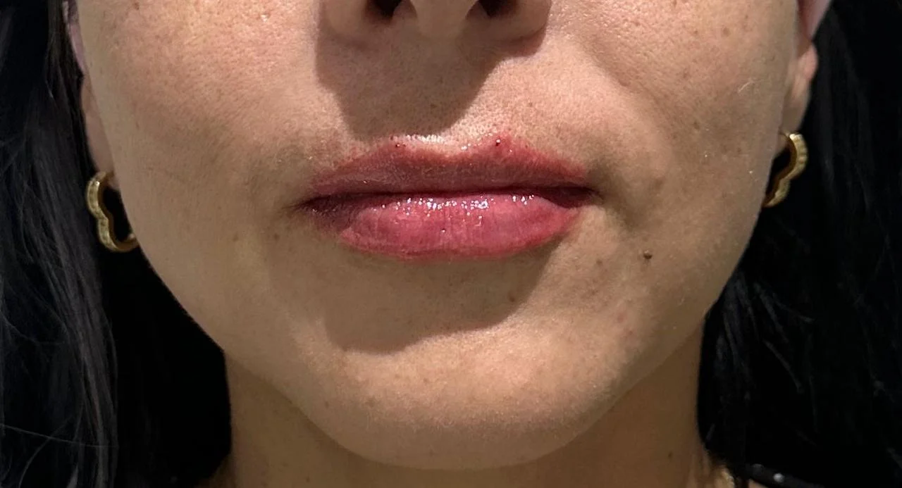 Resultado labios paciente 1 - después