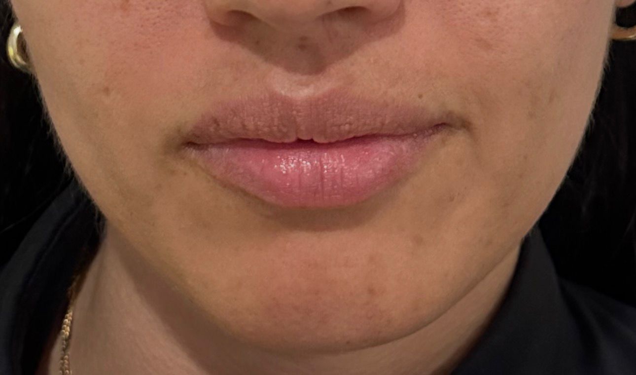 Resultado labios paciente 2 - antes