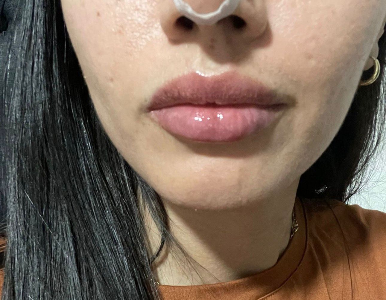 Resultado labios paciente 2 - después