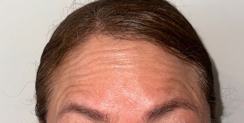 Resultado Botox paciente 1 - antes