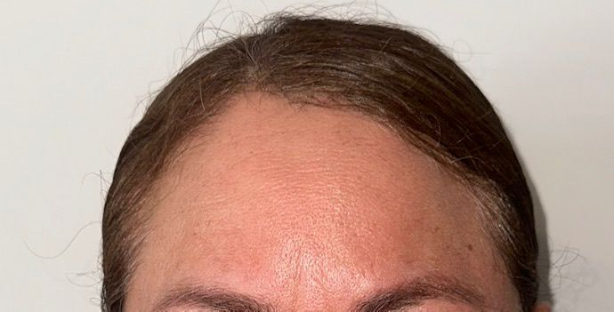 Resultado Botox paciente 1 - después