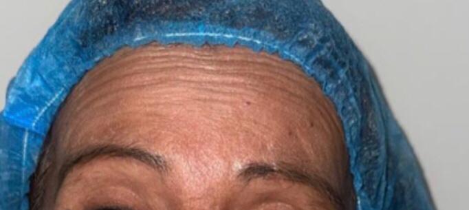 Resultado Botox paciente 2 - antes
