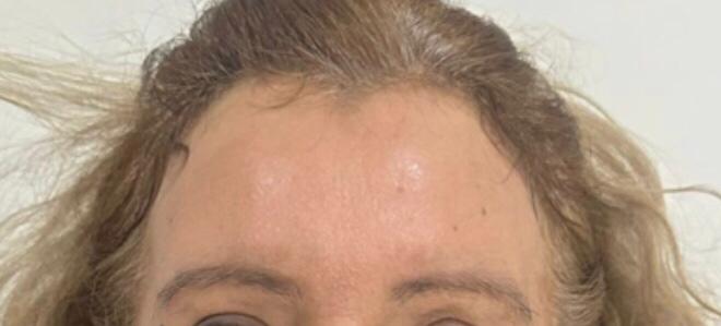 Resultado Botox paciente 2 - después